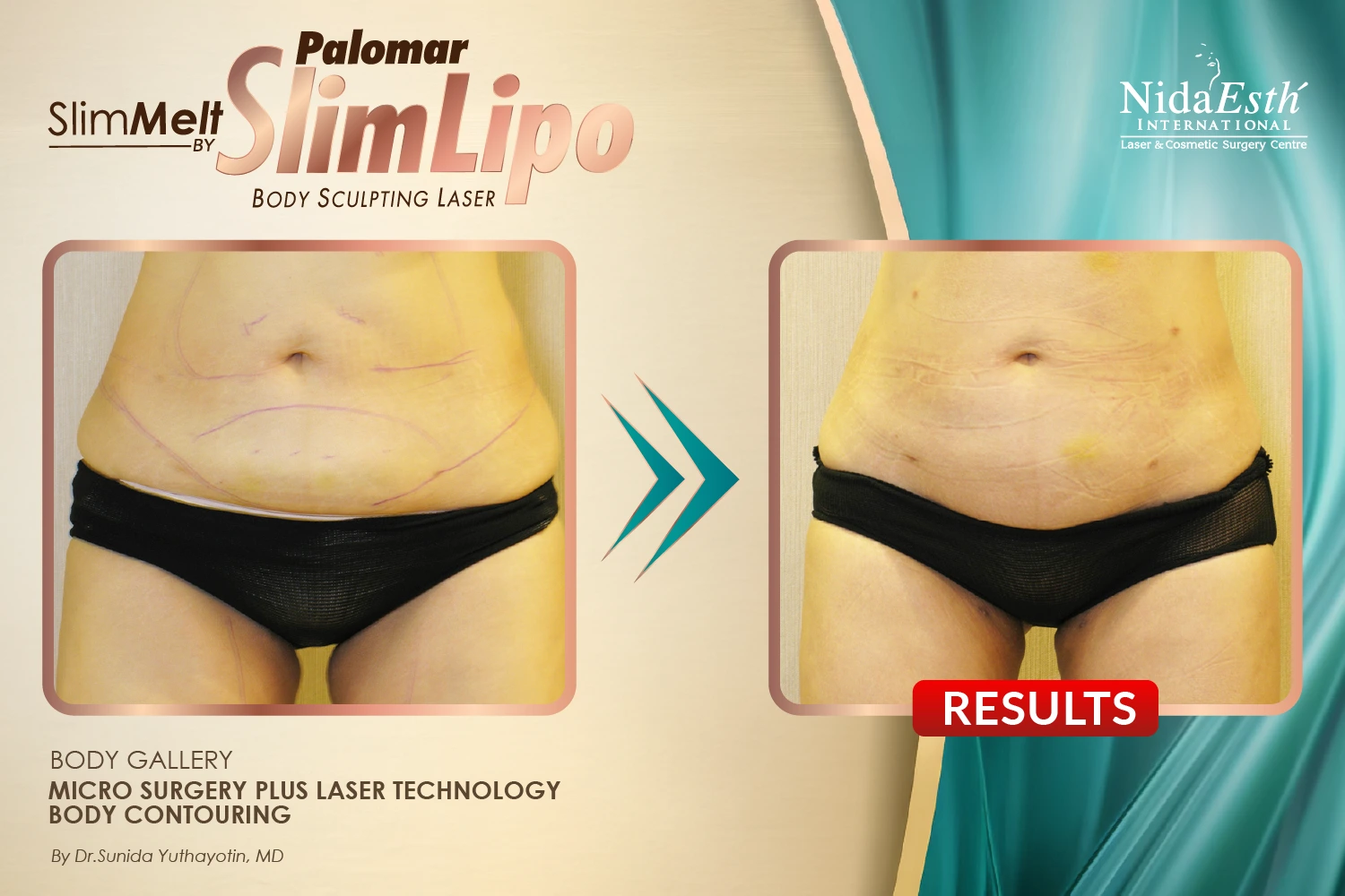 slimlaserthailand