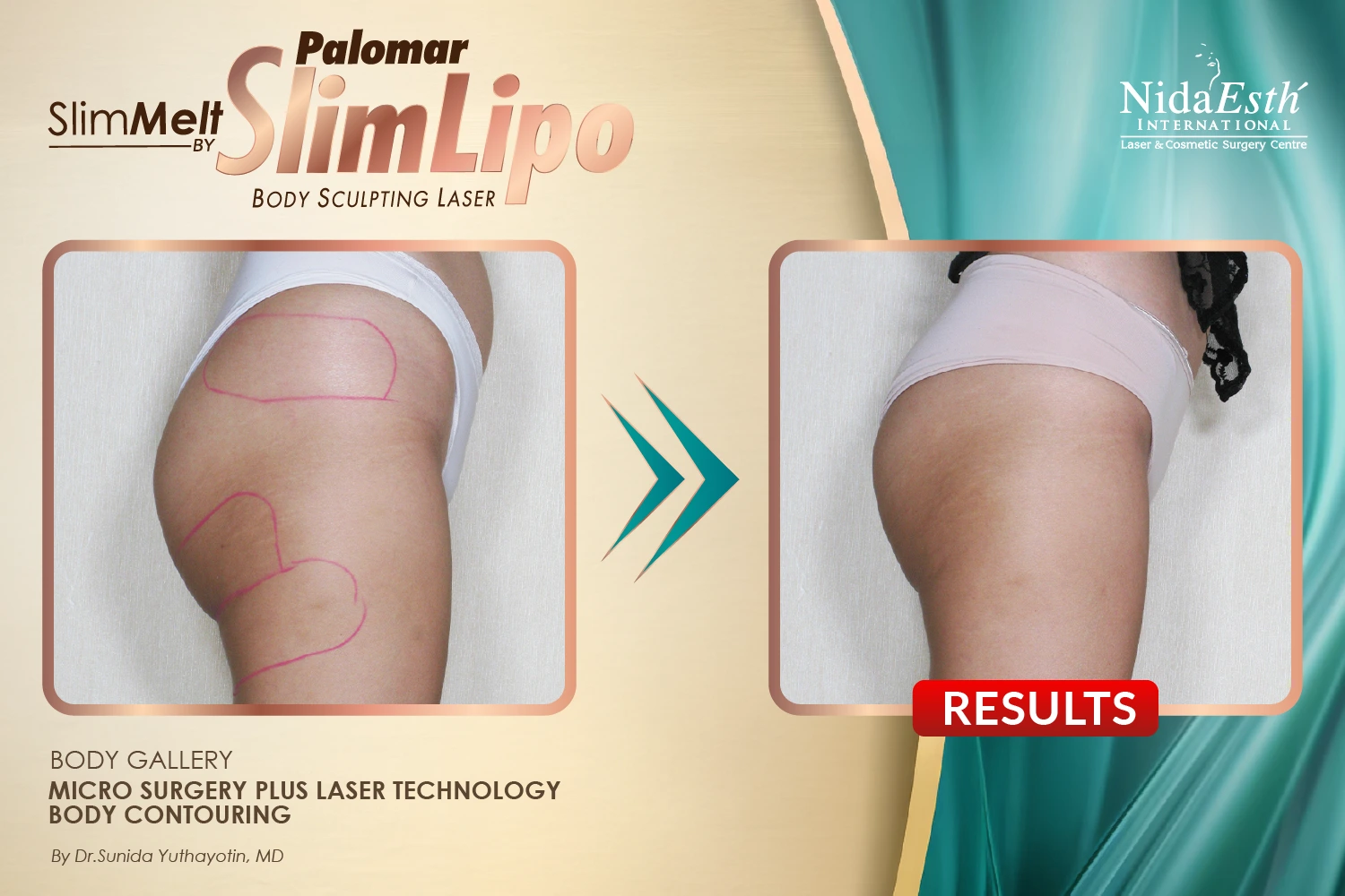 slimlaserthailand