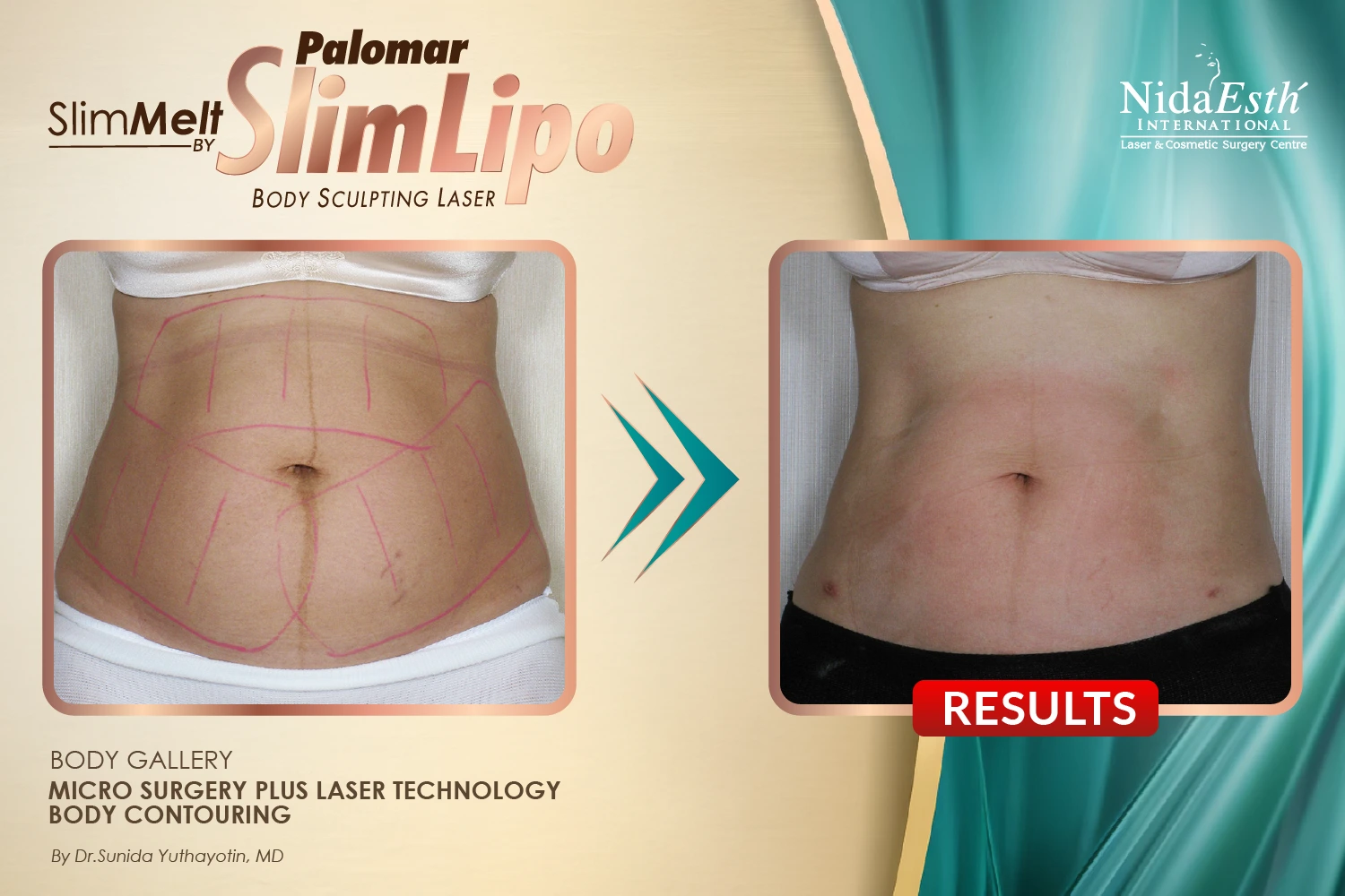 slimlaserthailand