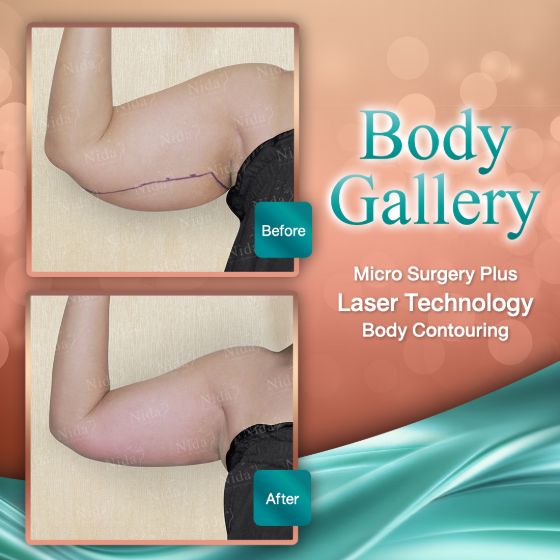 slimlaserthailand