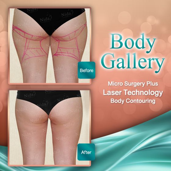 slimlaserthailand