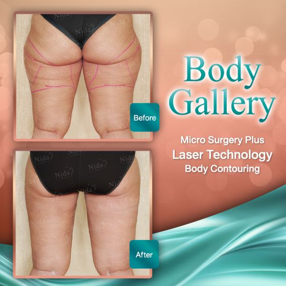 slimlaserthailand