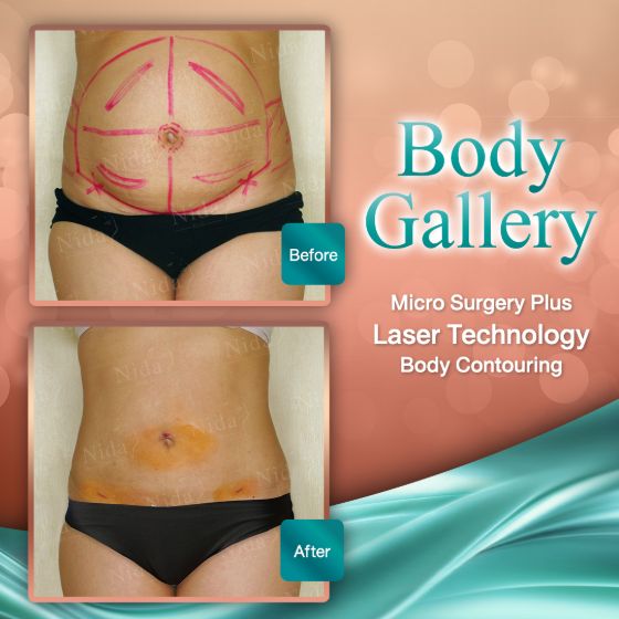 slimlaserthailand