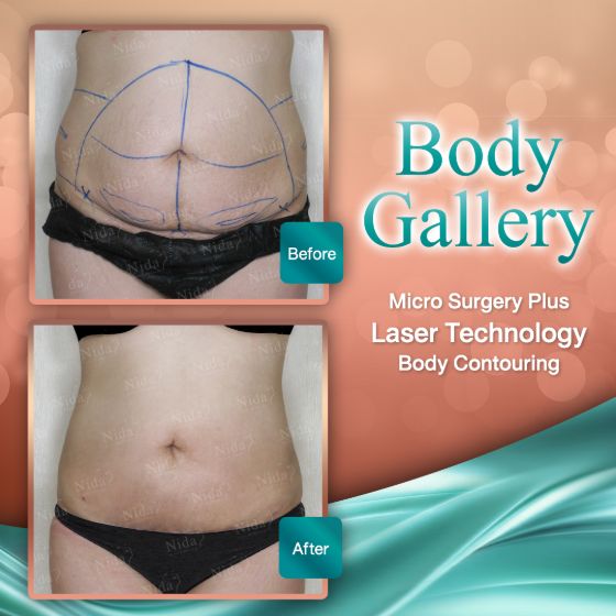 slimlaserthailand